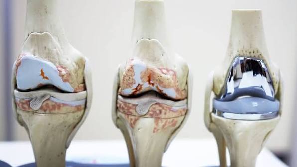 Revolutionizing Recovery: Navigating the Total Knee Arthroplasty Protocol